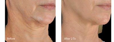 Skin Tightening and Wrinkle Reduction Before & After Gallery - Patient 49140210 - Image 1