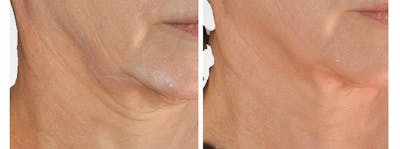 Skin Tightening and Wrinkle Reduction Before & After Gallery - Patient 49140211 - Image 1