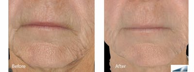 Skin Tightening and Wrinkle Reduction Before & After Gallery - Patient 49140213 - Image 1