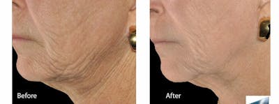 Skin Tightening and Wrinkle Reduction Before & After Gallery - Patient 49140215 - Image 1