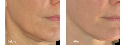 Skin Tightening and Wrinkle Reduction Before & After Gallery - Patient 49140216 - Image 1