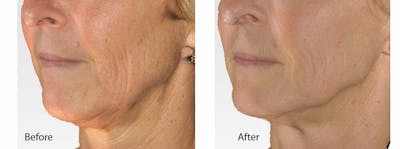 Skin Tightening and Wrinkle Reduction Before & After Gallery - Patient 49140217 - Image 1