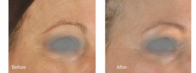 Skin Tightening and Wrinkle Reduction Before & After Gallery - Patient 49140219 - Image 1