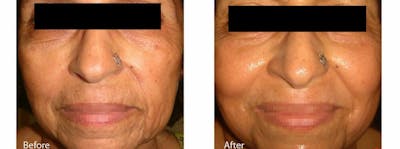 Skin Tightening and Wrinkle Reduction Before & After Gallery - Patient 49140221 - Image 1