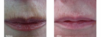 Skin Tightening and Wrinkle Reduction Before & After Gallery - Patient 49140222 - Image 1