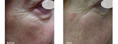 Skin Tightening and Wrinkle Reduction Before & After Gallery - Patient 49140223 - Image 1