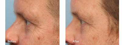 Skin Tightening and Wrinkle Reduction Before & After Gallery - Patient 49140224 - Image 1