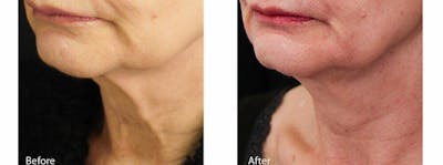 Skin Tightening and Wrinkle Reduction Gallery - Patient 49140228 - Image 1
