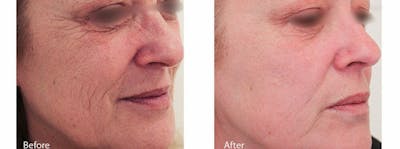 Skin Tightening and Wrinkle Reduction Before & After Gallery - Patient 49140229 - Image 1
