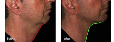 Skin Tightening and Wrinkle Reduction Before & After Gallery - Patient 49140236 - Image 1