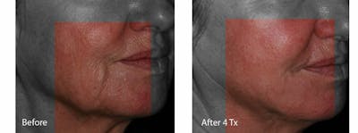 Skin Tightening and Wrinkle Reduction Before & After Gallery - Patient 49140239 - Image 1
