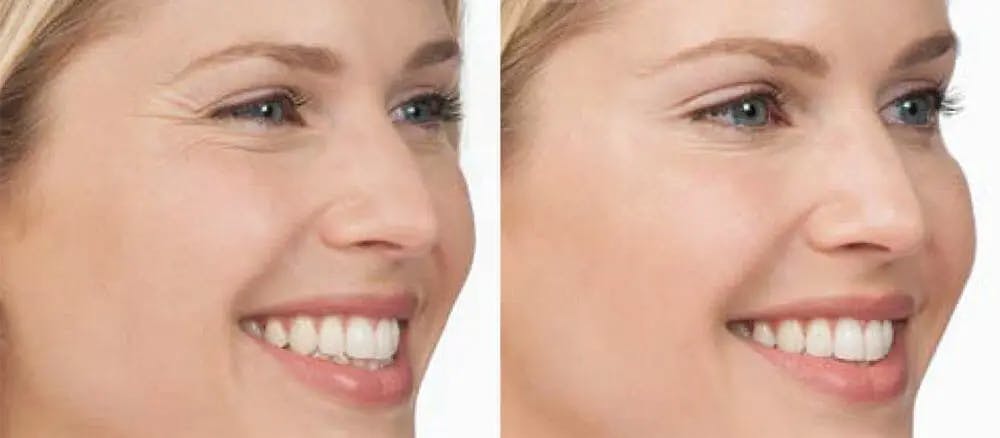 BOTOX