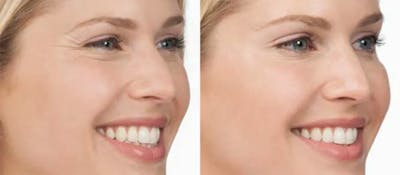 BOTOX Before & After Gallery - Patient 49140409 - Image 1