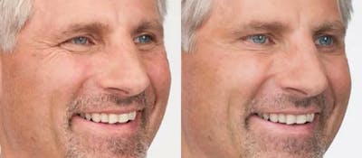 BOTOX Before & After Gallery - Patient 49140410 - Image 1