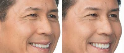 BOTOX Before & After Gallery - Patient 49140411 - Image 1