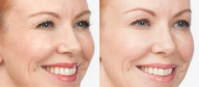 BOTOX Before & After Gallery - Patient 49140412 - Image 1