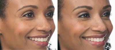 BOTOX Before & After Gallery - Patient 49140414 - Image 1
