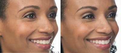 BOTOX Before & After Gallery - Patient 49140414 - Image 1
