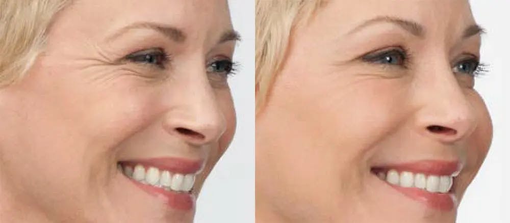 BOTOX