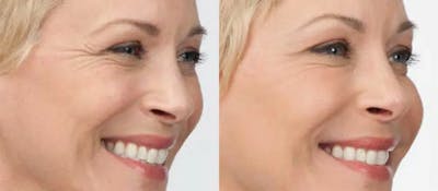 BOTOX Before & After Gallery - Patient 49140415 - Image 1
