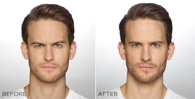 Dysport Before & After Gallery - Patient 49140416 - Image 1