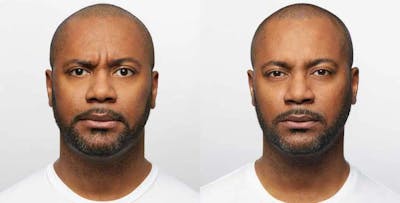 Dysport Before & After Gallery - Patient 49140417 - Image 1