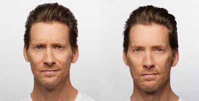 Dysport Before & After Gallery - Patient 49140418 - Image 1