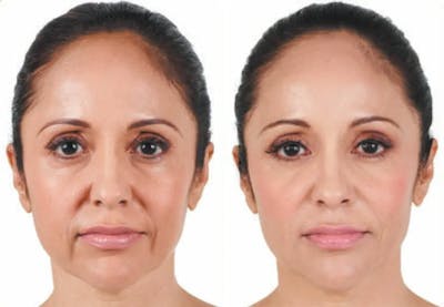 Juvederm Before & After Gallery - Patient 49140424 - Image 1