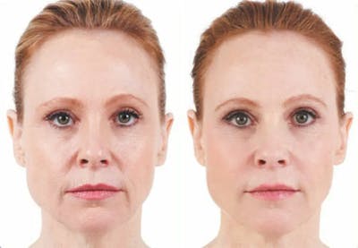 Juvederm Before & After Gallery - Patient 49140425 - Image 1