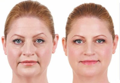 Juvederm Before & After Gallery - Patient 49140426 - Image 1