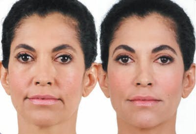 Juvederm Before & After Gallery - Patient 49140427 - Image 1
