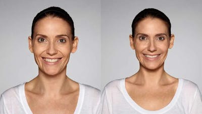 Restylane Before & After Gallery - Patient 49140430 - Image 1