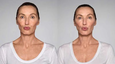 Restylane Before & After Gallery - Patient 49140432 - Image 1