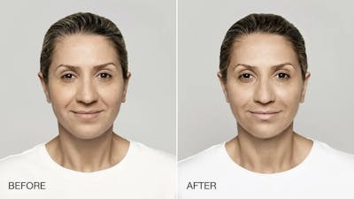 Restylane Before & After Gallery - Patient 49140433 - Image 1