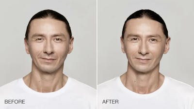 Restylane Before & After Gallery - Patient 49140434 - Image 1