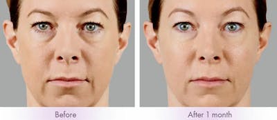 Voluma Before & After Gallery - Patient 49142225 - Image 1