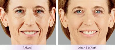Voluma Before & After Gallery - Patient 49142226 - Image 1