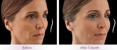 Voluma Before & After Gallery - Patient 49142227 - Image 1