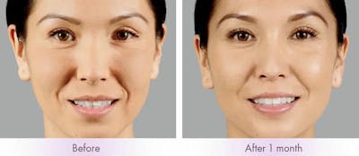 Voluma Before & After Gallery - Patient 49142228 - Image 1