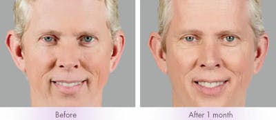 Voluma Before & After Gallery - Patient 49142229 - Image 1
