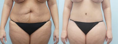 Body Lift Before & After Gallery - Patient 49149607 - Image 1