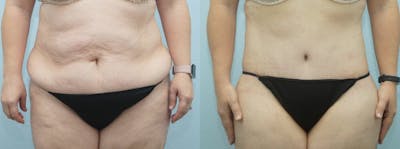 Body Lift Before & After Gallery - Patient 49149609 - Image 1