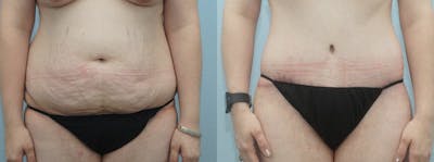 Body Lift Before & After Gallery - Patient 49149611 - Image 1