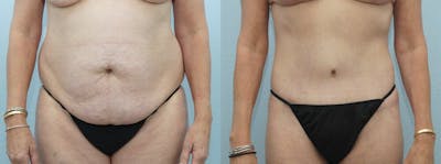 Body Lift Before & After Gallery - Patient 49149612 - Image 1