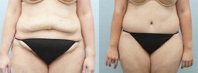 Body Lift Before & After Gallery - Patient 49149614 - Image 1