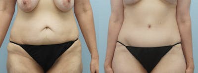 Body Lift Before & After Gallery - Patient 49149616 - Image 1