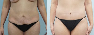 Body Lift Before & After Gallery - Patient 49149619 - Image 1