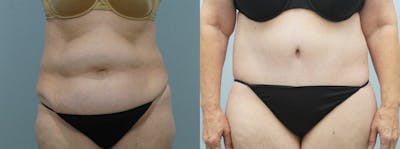 Body Lift Before & After Gallery - Patient 49149623 - Image 1