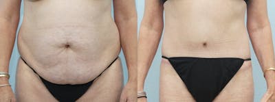 Body Lift Before & After Gallery - Patient 49149628 - Image 1