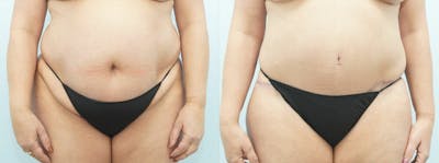 Body Lift Before & After Gallery - Patient 49149632 - Image 1